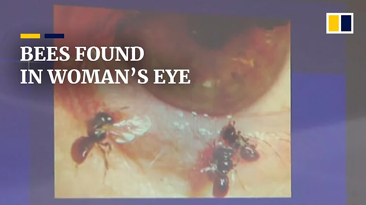 Doctors remove ‘sweat bees’ living off tears in Taiwanese woman’s eye - DayDayNews