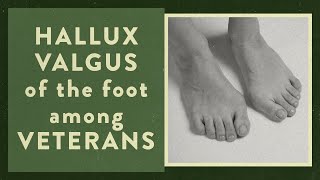 Hallux valgus of the foot among Veterans