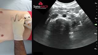 Notfallsonografie - Graduelle Kompression für Aorta oder Vena cava inferior