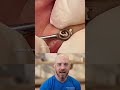 Whitehead Removal Technique: Needle vs. Plasma Pen
