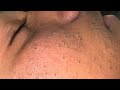 Satisfying Blackhead & Pimple Popping | Best Acne Solutions