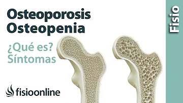 ¿Qué puede empeorar la osteoporosis?