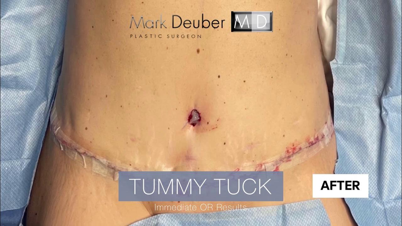 Tummy tuck immediate before & after results 