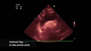 Aortic dissection Type I