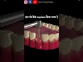 How To Fit False Teeth Shorts Teeth How To Fit False Teeth Shorts Teeth