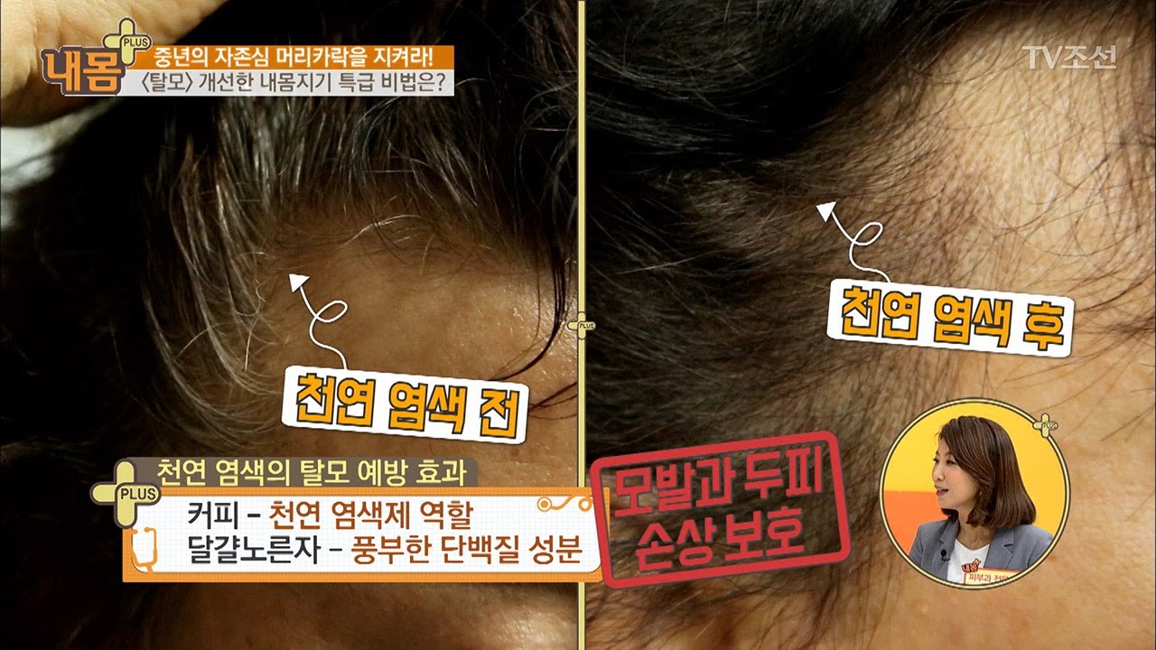 탈모를 혼자서 극복한 내몸지기의 특별한 비결?! [내 몸 플러스] 64회 20170630