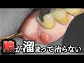 『 根尖病巣 』は本当に治らないのか…？抜歯する前に見て！　#根尖病巣　#フィステル #根管治療　#歯医者　#膿が溜まる