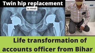 Recovery in Double hip replacement-How long does it take?दोनों कूल्हों के रिप्लेसमेंट के बाद रिकवरी