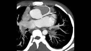 STR Cardiothoracic Case Webinar 1/14/2021