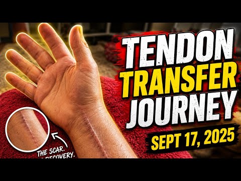Tendon Transfer Journey September 17, 2025