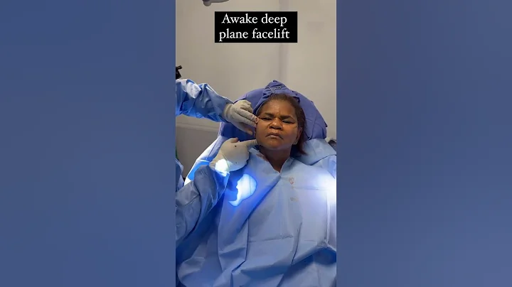 Results of an AWAKE DEEP PLANE FACELIFT