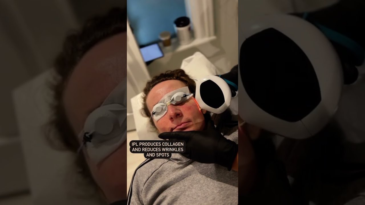 IPL with Artisan Aesthetics Port Hope