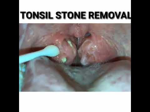 How to remove caseum from your tonsils 