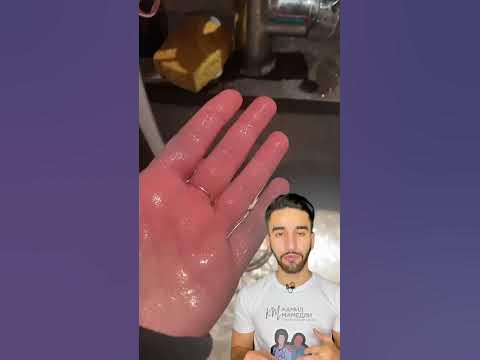 синдром Рейно - YouTube