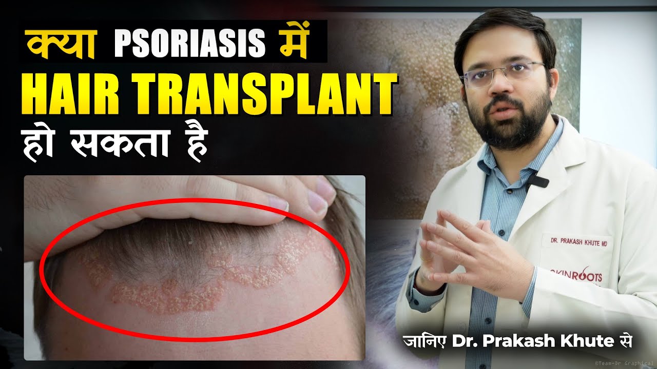 Can Psoriasis Patients Undergo Hair Transplant?  Expert insight  by Dr. Prakash Khute MD AIIMS Delhi