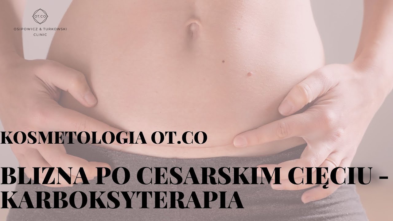 Karboksyterapia na bliznę po cesarskim cięciu