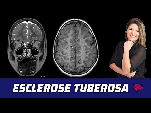 Vídeo: 3 maneiras de diagnosticar a esclerose tuberosa