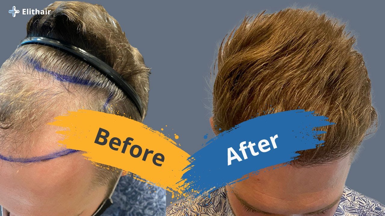 Hair Transplant Before and After - Month by Month results Elithair