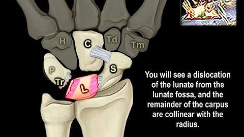 Perilunate Instability & Dislocation - Everything You Need To Know - Dr. Nabil Ebraheim