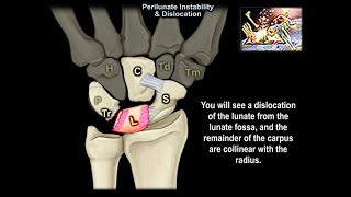 Perilunate Instability & Dislocation - Everything You Need To Know - Dr. Nabil Ebraheim