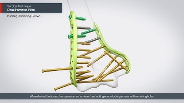 [ARIX OS] ARIX Elbow - Distal Humerus Surgical Guide