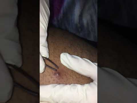 HUGE INGROWN HAIR WITH PUS!!! - YouTube