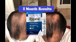 Does Rogaine REALLY Work 8 Month RESULTS | MENS ROGAINE (5% Minoxidil) Hair Regrowth Treatment