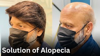 Solution of Alopecia | Full Cap Hair Patch | Hair Look Club
