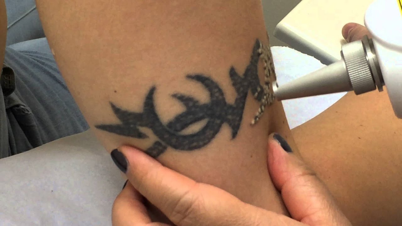 Tattoo Removal and Results at Laserexpress in Dublin - YouTube