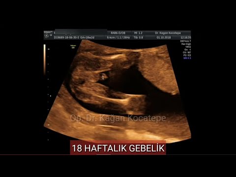 Video: 18 haftalık ultrason cinsiyeti söyleyebilir mi?