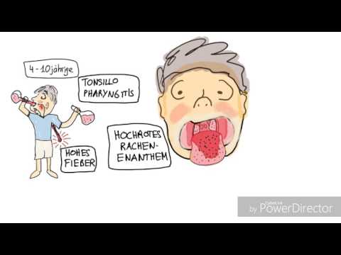 Video: Kawasaki-Krankheit erkennen und behandeln – wikiHow
