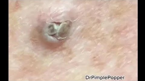 WHAT is this on the arm Extractions with Dr  Pimple Popper #shorts #dpow