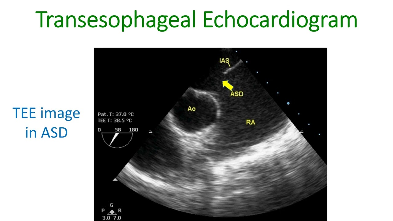 What is Transesophageal Echocardiogram (TEE)? - YouTube