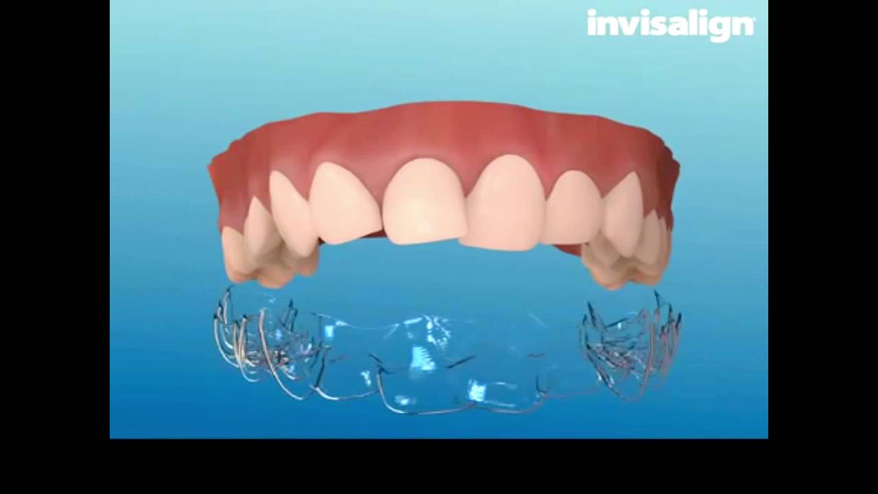 Como funciona el invisalign