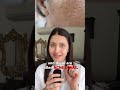 How To Fix Acne Scars Dr Jushya Sarin 