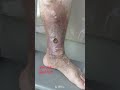 قبل و بعد علاج قرحة الساق عند رجل في الستينات 