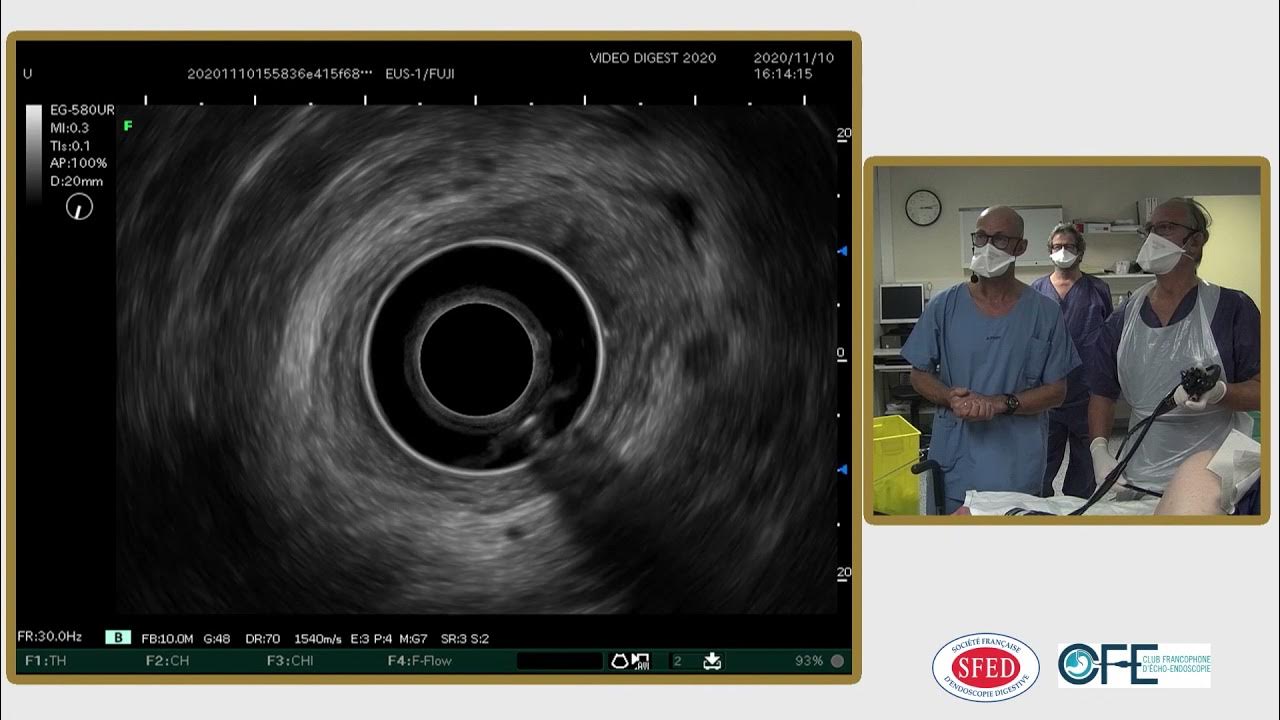 Evaluation par échoendoscopie et conduite à tenir devant un