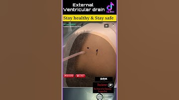 External ventricular drain