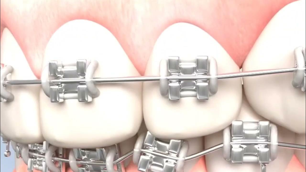What is a Biteblock ? ( Orthodontic Braces Tips & Tricks) by Dr.Myat Ko