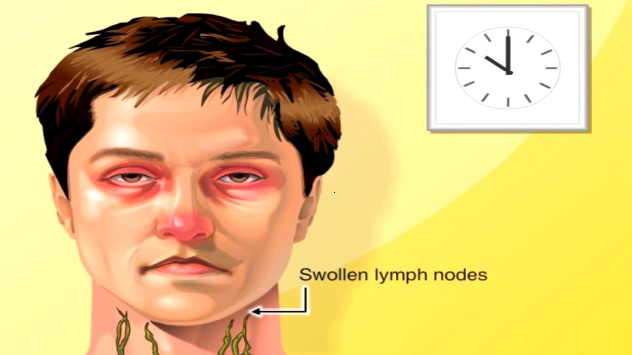 Why Lymph Nodes Swell Animation Lymphatic System Structure