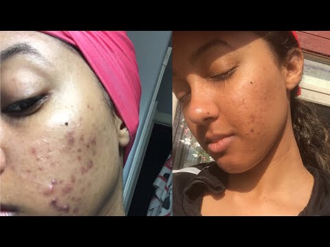 WHAT IS CAUSING MY ACNE- PART 