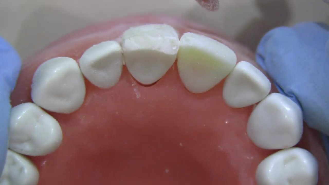 anterior composite polishing