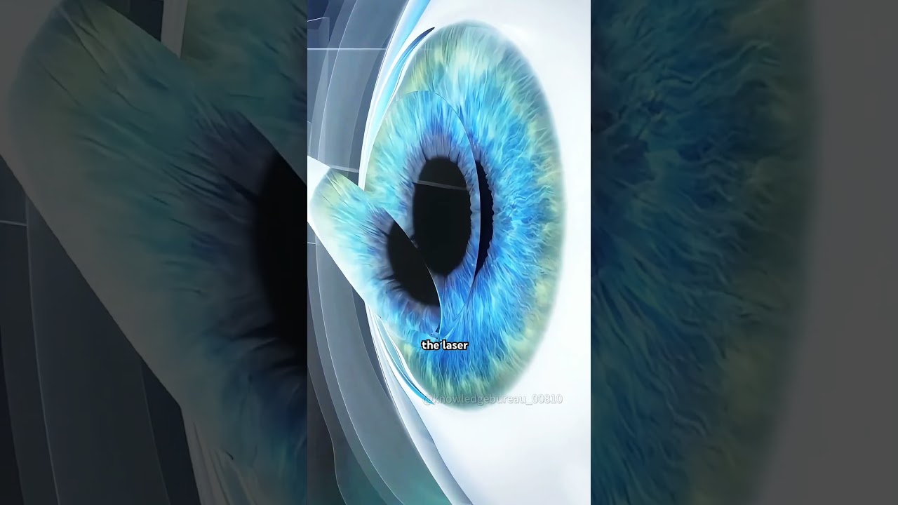 LASIK Eye Surgery (3D Animation) 