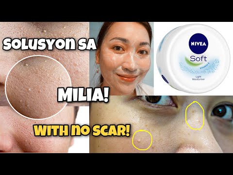 PAANO MAGTANGGAL NG MILIA-BUTLIG AT HOME Safe Easy & Scar Free | FEAT. Nivea Cream | ayaesguerra