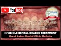 Invisible Ceramic Dental Braces Treatment in Kolkata | Orthodontist in Kolkata | Cosmetic Dentistry