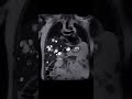 Polycystic liver #ctscan #mri #mrcp #abdomen #liver#shorts #viral #mriscan