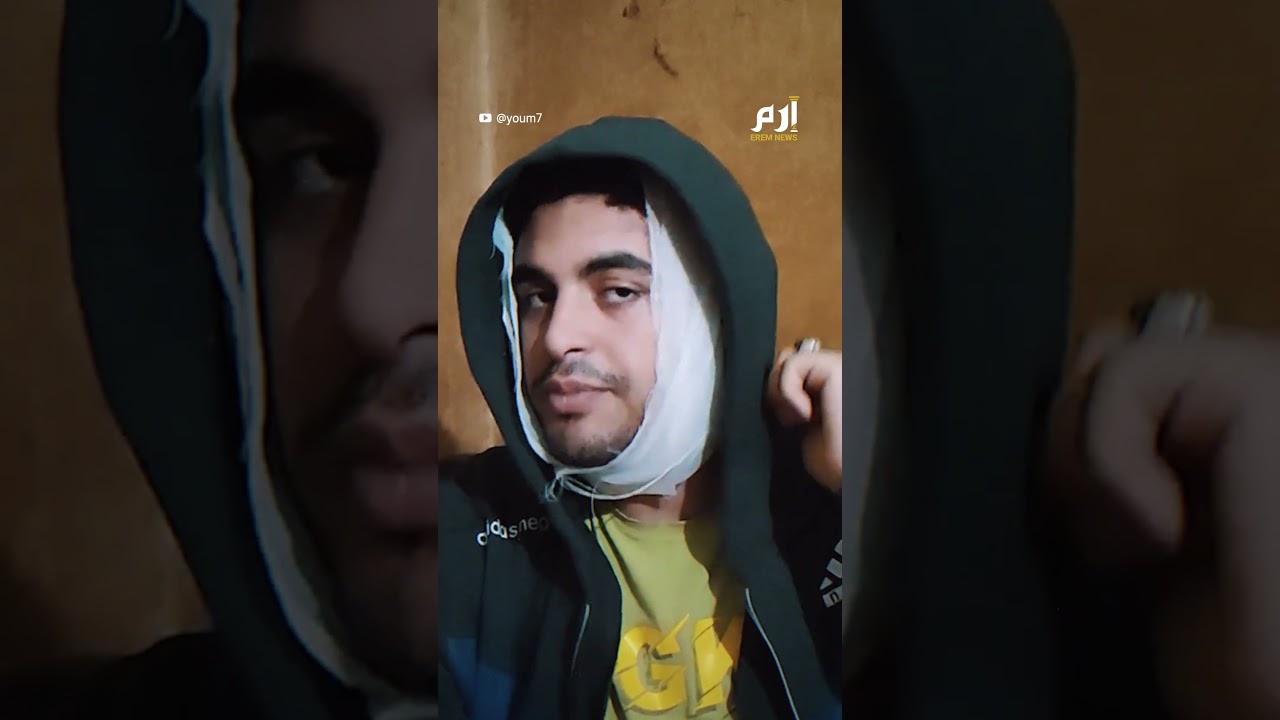 مصر.. شوه وجهه بـ 115 غرزة بعد رفضه طلب الصداقة على فيسبوك
