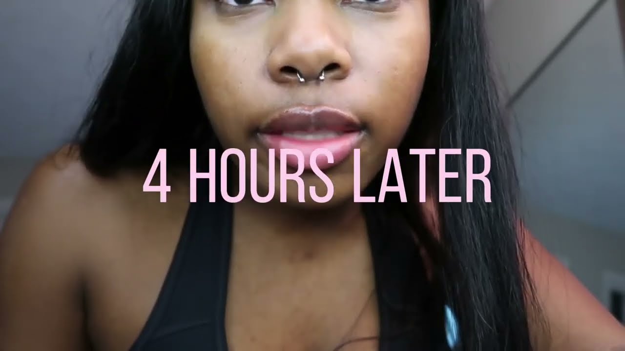 FIRST TIME GETTING LIP FILLER | BLACK GIRL WITH FILLER 💕