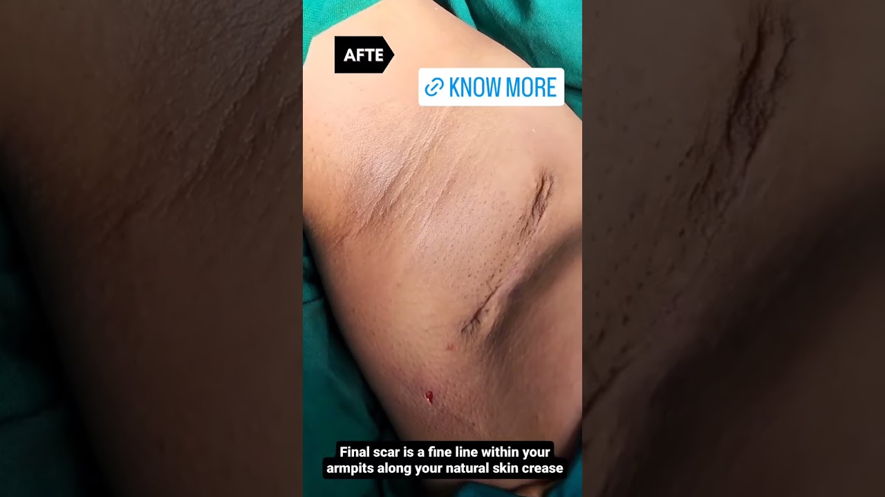 Armpit tissue removal |  Accessory breast removal | Dr Karishma Aesthetics Bengaluru India 