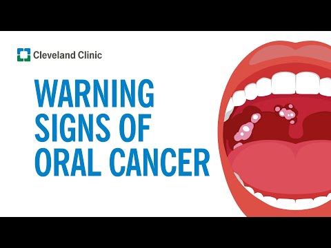Video: Sådan genkendes tegn på oral kræft: 11 trin (med billeder)